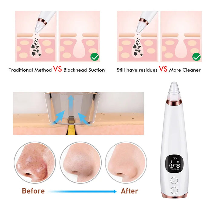 Vacuum Blackhead Remover